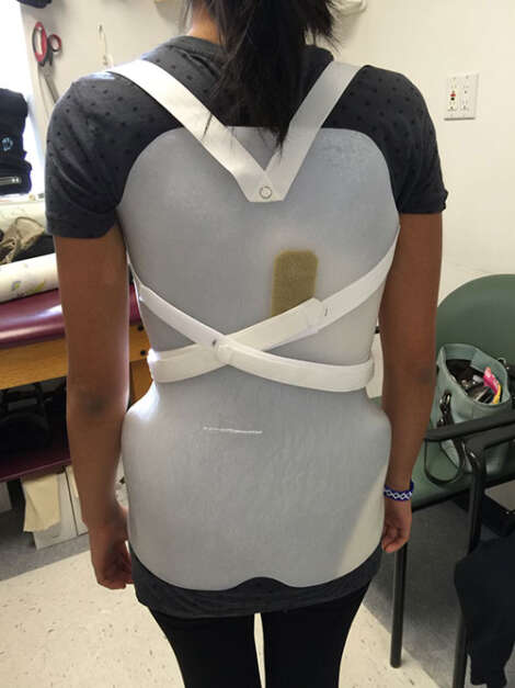 Scoliosis Bracing – NBB Orthotics