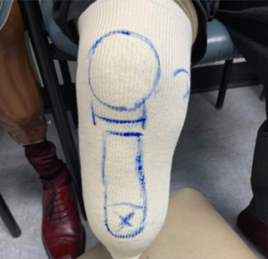 Does Your Prosthesis Fit Properly?